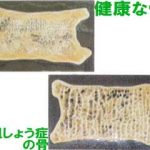 腸由来セロトニン合成の阻害薬:骨形成促進による骨粗しょう症治療の可能性