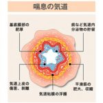「選手が病気(喘息)を言い訳にせず」がダメな理由