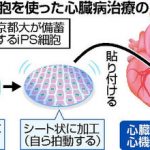 備蓄する他人のiPS細胞から作成した心筋細胞のシートによる心臓病治療について