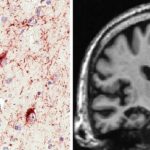 新しい認知症、大脳辺縁系優位型老年期TDP-43脳症(Limbic-predominant age-related TDP-43 encephalopathy、LATE)