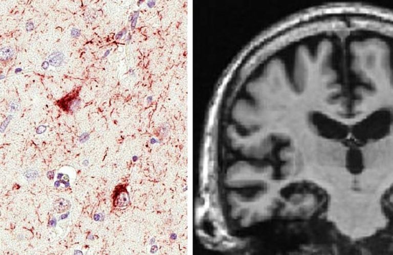 新しい認知症、大脳辺縁系優位型老年期TDP-43脳症（Limbic-predominant age-related TDP-43 encephalopathy、LATE）